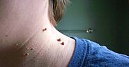 Dermatologist Skin Tag Removal : How To Remove Skin Tags In One Night