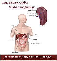 Laparoscopic Splenectomy Surgery, Treatment & Cost Texas USA