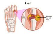 Bệnh gout là gì?