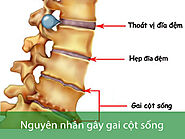 Nguyên nhân bị gai cột sống