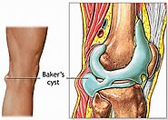 Nguyên nhân gây bệnh tràn dịch khớp gối