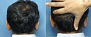 Top hair loss treatment in Ahmedabad