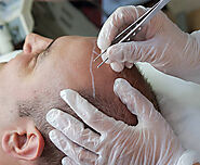 Best hair transplant Clinic Mansi circle at unbelievable prices