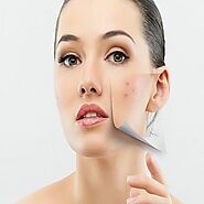 Excellent anti-acne treatment in Ahmedabad at competitive prices