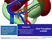 More About Liver Transplant in Delhi
