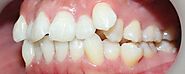 Răng mọc lệch ở trẻ, nguyên nhân và cách khắc phục - Nha Khoa Đại Nam