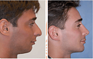 Rhinoplasty is anti-aging | one in all solution