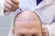 FUE Hair Transplant In Turkey – Its Safety, Convenience, And Cost