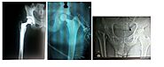 Hip Replacement Surgeon In Mulund | Total Knee & Hip Surgery in Thane - Bone & Joint Care