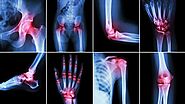 Treatment for Arthritis | Philadelphia Homeopathic Clinic | Dr. Tsan & Assoc