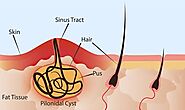 Best Treatment for Pilonidal Sinus by Jindal Laparoscopy Hospital