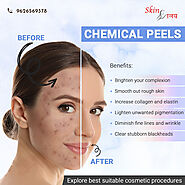 Using Chemical Peels to Rejuvenate Your Skin