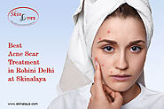 Best Acne Treatment in Delhi | Best Acne Treatment in Rohini Delhi