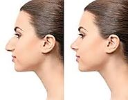 All You Wanted to Know About Rhinoplasty