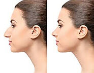 Rhinoplasty - Know Your Nose - HealthCareDynamic135