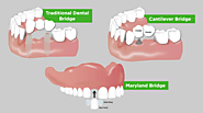 4 Types of Dental Bridges Everyone Should Know About
