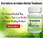 Use Natural Remedies for Granuloma Annulare to Get Rid of it