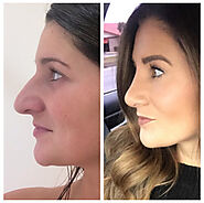 Frequently Asked Questions Regarding Rhinoplasty