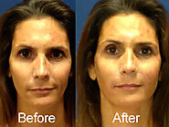 Fillers - Calwest Surgical Institute