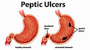 Complication of Untreated Peptic Ulcer Disease
