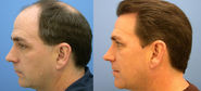 Hair Transplant Services in Pakistan