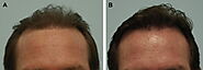 Complications That May Arise After A Hair Transplant Surgery