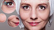 What is Profhilo? Treatment For Skin Restoring, Remodeling & Tightening | Euromed® Clinic Dubai