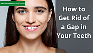 How To Get Rid Of A Gap In Your Teeth