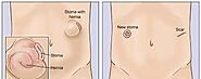 What is Laparoscopic Abdominal Hernia Operation?