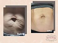 Effective Scar And Stretch Marks Treatment