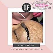 Benefits Of Non Laser Tattoo Removal