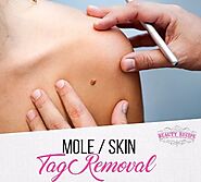 Get Easy Mole Removal Treatment In Singapore