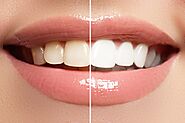 Achieve a Brighter Smile with Our Teeth Whitening Services | Prime Dental PA