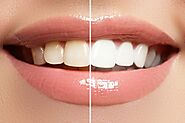 Achieve Dazzling Smiles: Premier Teeth Whitening Solutions in Mount Pleasant