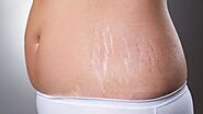 Effective Stretch Mark Removal Remedies