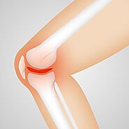 L'arthroscopie du genou : soigner l'arthrose avec la chirurgie