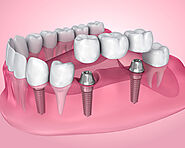 Dental Implants in SW Calgary
