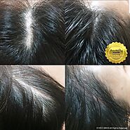 Scalp Micro Pigmentation — The Best Hair Loss Solution