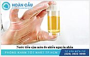 Nước tiểu màu vàng đậm là vì sao? Chữa như thế nào?