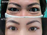 Know About The Benefits Of Eye Bag Removal