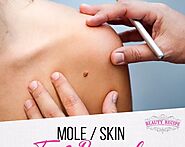 Skin Tag Removal Singapore: How Does It Work? Why Should You Pay a Specialist Visit?