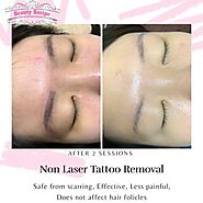 Things To Know About Non Laser Tattoo Removal