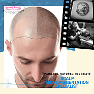 Scalp Micro Pigmentation The Best Hair Loss Solution