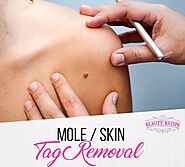 Website at https://beautyrecipe.com.sg/mole-skin-tag-removal/