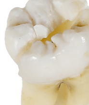 The Symptoms and Treatments for Wisdom Tooth Infection