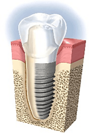 Services I Dental Implant & All-On-4® Centre I Next Smile™