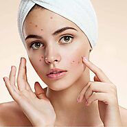 Acne Doctor Treatment in Delhi: The Solution You’ve Been Searching For - Buddies Reach