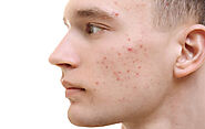 How To Get Rid of Acne From Skin?