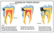 Teeth Whitening: Procedure and After-Care Tips