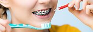 Braces Care: How to Brush Teeth and Floss with Braces and Foods to Avoid